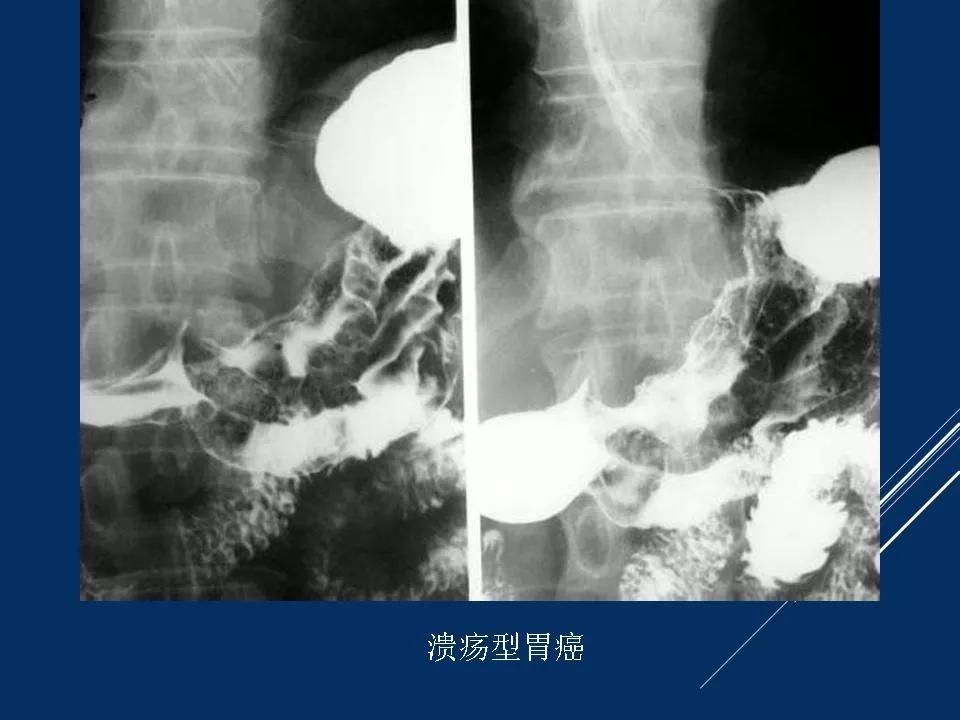 胃肠间质瘤最新治疗药物的探索与突破