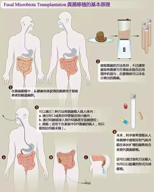 最新粪菌移植成功案例及其影响